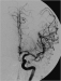 Aktuelles Bild - Abb. 3: Karotis-T-Verschluss