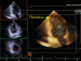Abb. 5: Thrombus