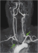 Abb. 1: MR-Angiographie