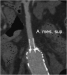 Abb. 6: CT - MIP-Rekonstruktion