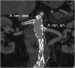 Aktuelles Bild - Abb. 7: CT - MIP-Rekonstruktion