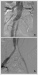 Abb. 3a-b: Aortenstentgraft