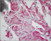 Abb. 7: Histologie der Myokardbiopsie
