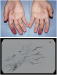 Abb. 1: Raynaud-Phänomen