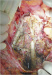 Abb. 9: Aortenaneurysma