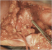 Abb. 12: Aneurysma