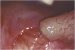 Abb. 7: Tubulovasostomie