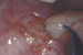 Abb. 8: Tubulovasostomie