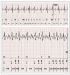 Abb. 3: EKG