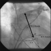 Abb. 2: Pulmonalvenenangiographie