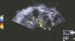 Aktuelles Bild - Abb. 3: Schwangerschaft - Krebsdiagnose