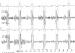 Abb. 4: QRS-Komplex - Signalmittelung
