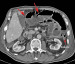 Aktuelles Bild - Abb. 1a: Dünndarmschlinge - Distension