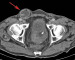 Abb. 1c: Dünndarmschlinge