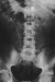 Aktuelles Bild - Abb. 4: Pigtail-Katheter