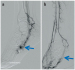 Abb. 7a-b: Angiographisches Bild