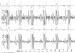 Abb. 5: QRS-Komplex - Signalmittelung