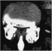 Abb. 5: Spinalkanalstenose