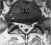 Abb. 6: Bandscheibenvorfall