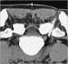 Abb. 8: Nervenwurzelinfiltration