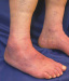 Abb. 2: Acrodermatitis chronica atrophicans