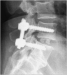 Aktuelles Bild - Abb. 11: Spondylodese
