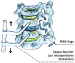 Abb. 2: ACDF - PEEK