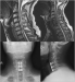 Abb. 4a-d: HWS - MRT