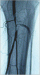 Abb. 6: Thrombusaspirationsembolektomie