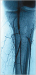 Abb. 7: Thrombusverschleppung