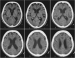 Abb. 1: Schizophrenie