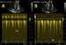 Aktuelles Bild - Abb. 8A-B: cw-Doppler im LVOT