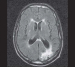 Fig. 4: FLAIR-MRI