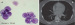 Fig. 2a-b: CSF-Cytology
