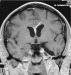 Abb. 1: Neurosarkoidose