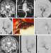 Abb. 5a-i: Aneurysma per magna