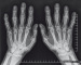 Aktuelles Bild - Abb. 1: Arthrose