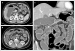 Abb. 1a-c: Morbus Crohn