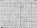 Aktuelles Bild - Abb. 1: AV-Block III. Grades