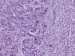 Abb. 4: Lebermetastasen