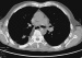 Abb. 3: Low-dose-CT