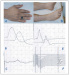 Fig. 2: Cisplatinum neuropathy