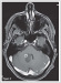 This Image - Fig. 2: Brain Tumour