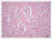 Fig. 4: Brain Tumour  