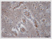 Fig. 5: Brain Tumour 