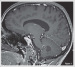 Fig. 3: Brain Tumour