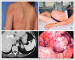 Abb. 1a-d: Cushing-Syndrom