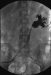 Abb. 3: Nephrostomie 