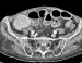 Abb. 2a: Abdomen - Tumor