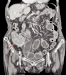 Abb. 2b: Tumor - Zökum